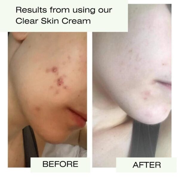 Purity Natural Beauty Clear Skin Cream Before and After